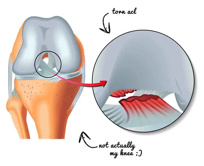 Torn ACL